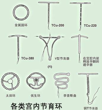 女性取环什么时间合适?哪些情况应取出节育环?