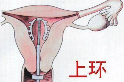 月经后几天上环***好?上环后有什么副作用?