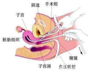 什么情况下需要清宫？清宫后需要休息多久？