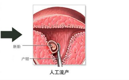 什么情况下需要清宫？清宫后需要休息多久？