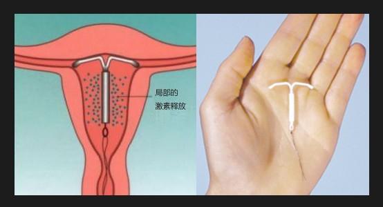 上环后要注意什么?还需注意这6项