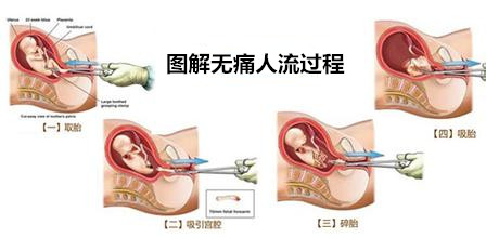 人流怎么做的过程图解 三大步骤带你轻松人流