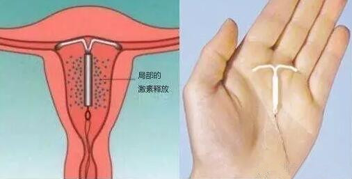 为了长久避孕考虑想上环，请问淮安上环多少钱啊?