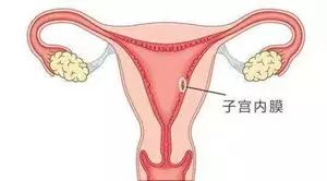 人流之后怎么护理子宫?术后,你该这样做……