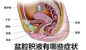 【盆腔积液有哪些症状】出现这些症状时,要小心!