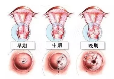 【疑问】宫颈糜烂可以自愈吗?医生提醒,宫颈糜烂需重视!