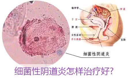 细菌性阴炎怎么治疗?这么详细还不赶紧收了!