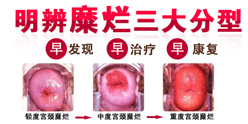 宫颈糜烂二度怎么治疗?【选对方法,少走捷径!】