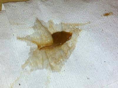 没有来月经但是有褐色的分泌物，肿么肥事?